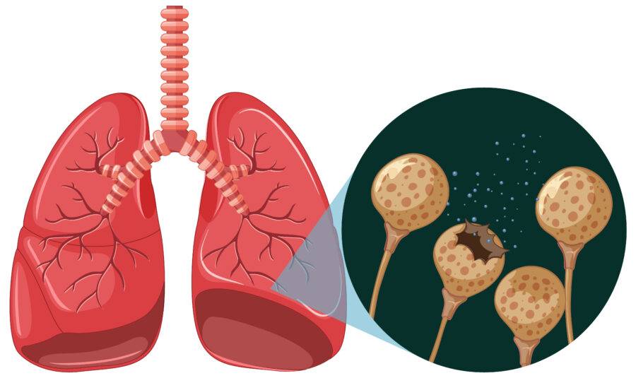 Non-Small Cell Lung Cancer Market